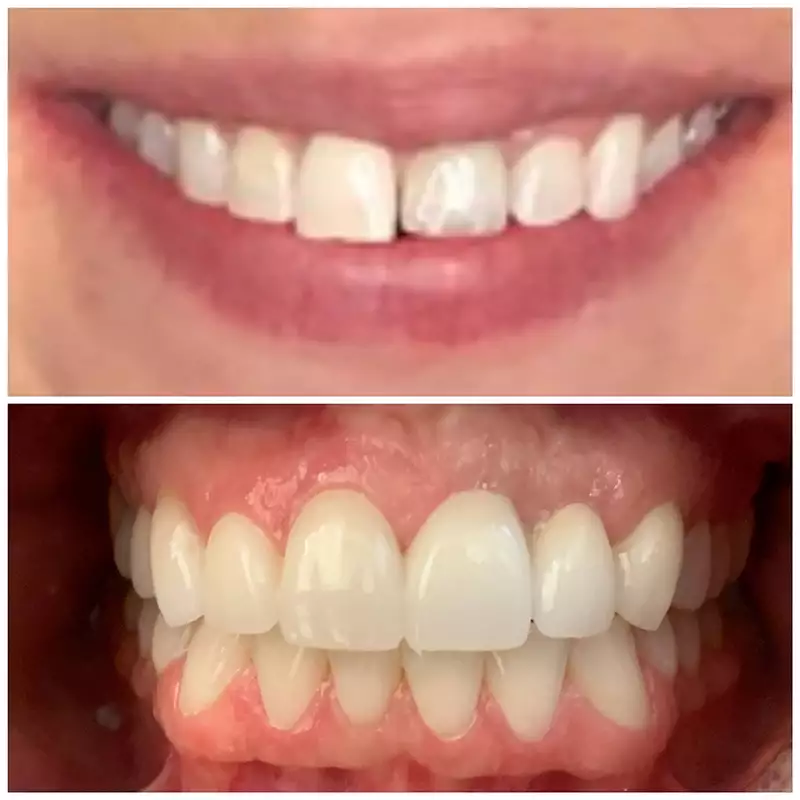 Smile Makeover Before & After 12