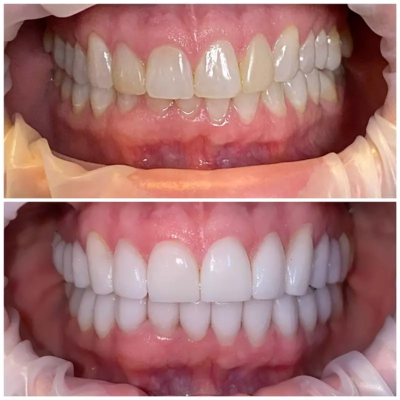 Smile Makeover Before & After 2