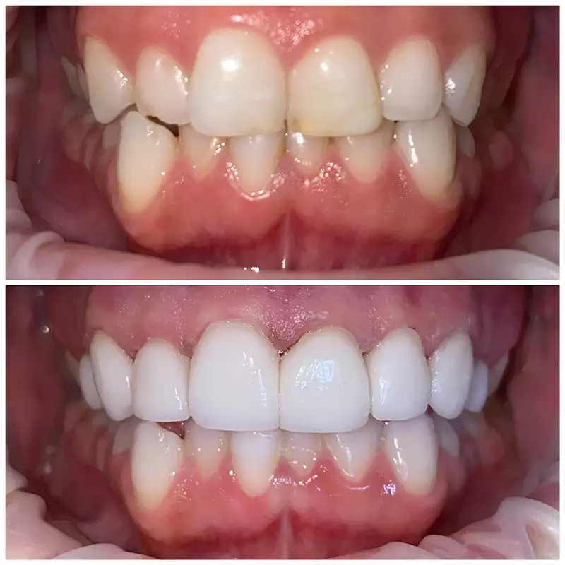 Smile Makeover Before & After 8