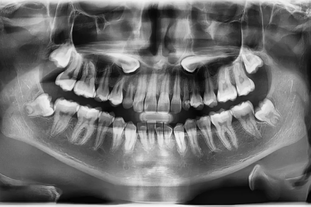 Wisdom Teeth X-Rays